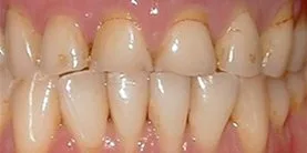 After - Porcelain Crown Case 1