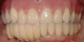 After - Porcelain Crown Case 3