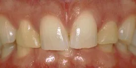 After - Porcelain Crown Case 4