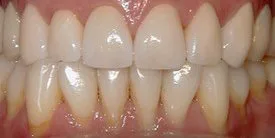 Before - Porcelain Crown Case 1