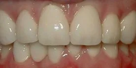 Before - Porcelain Crown Case 4