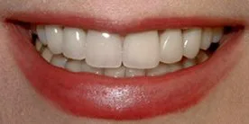 Before - Porcelain Crown Case 5