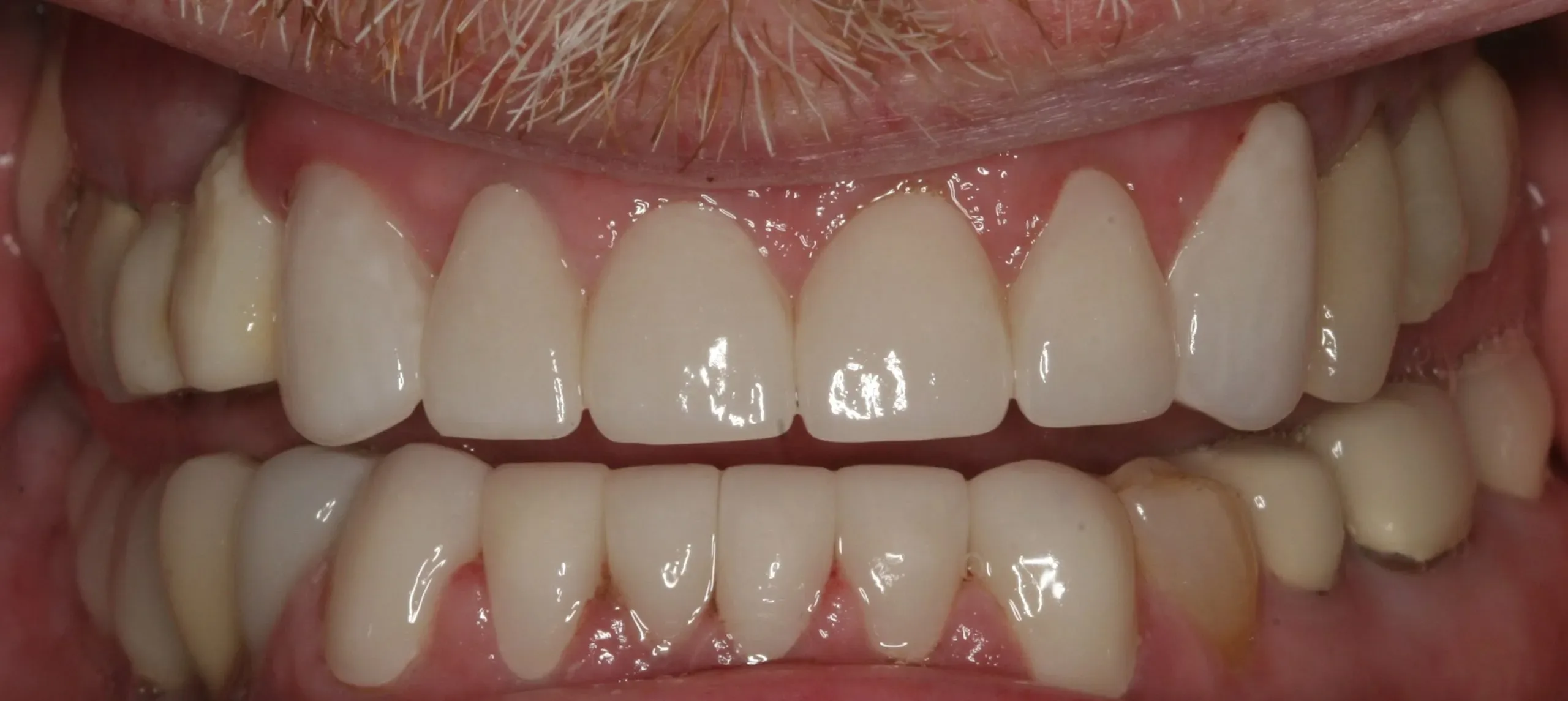 After treatment - Restorative Smile Rehabilitation