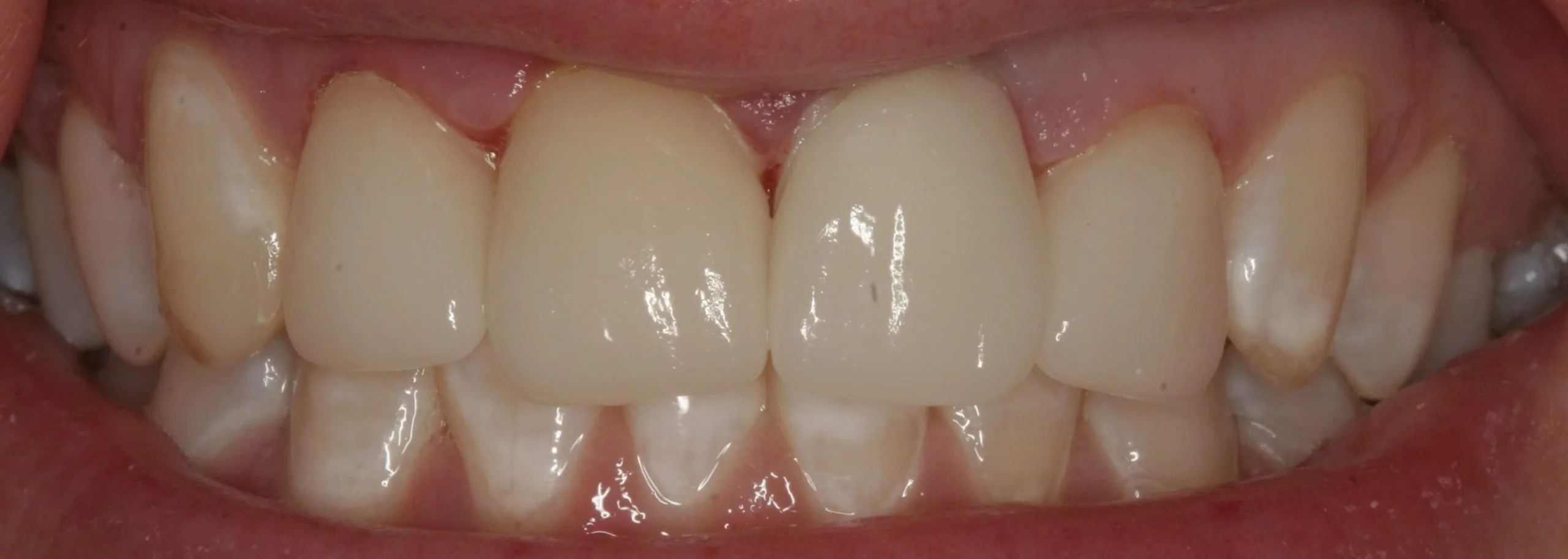 After treatment - Cosmetic Correction