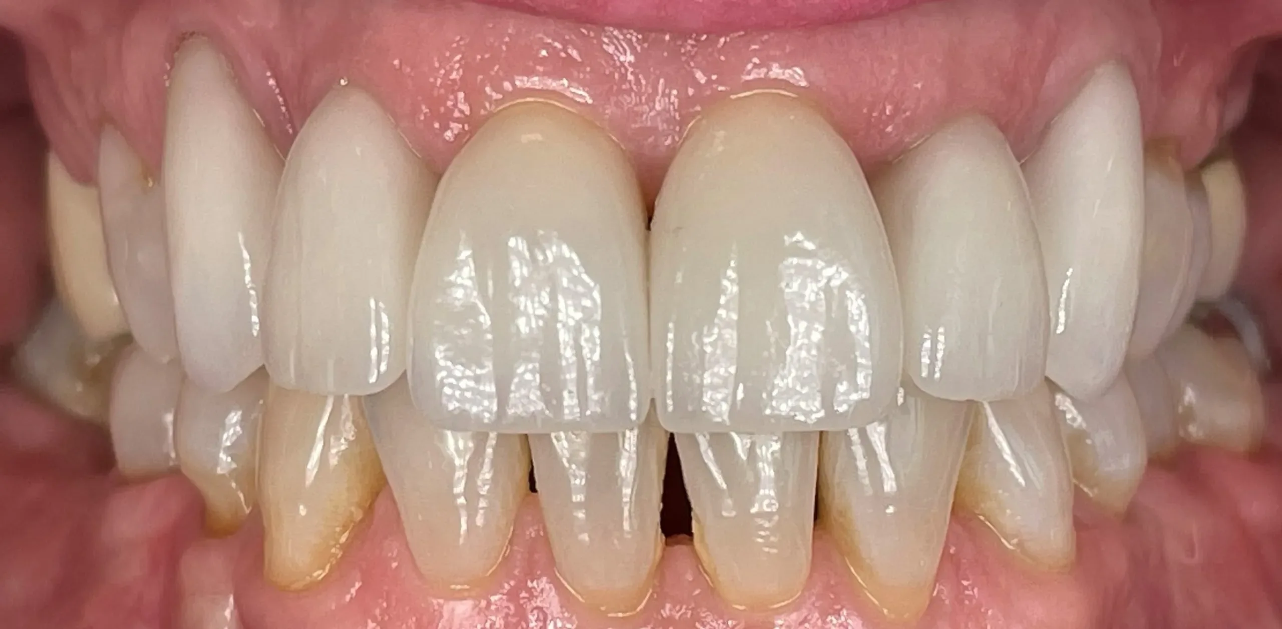 After: Cosmetic dental treatment retracted view