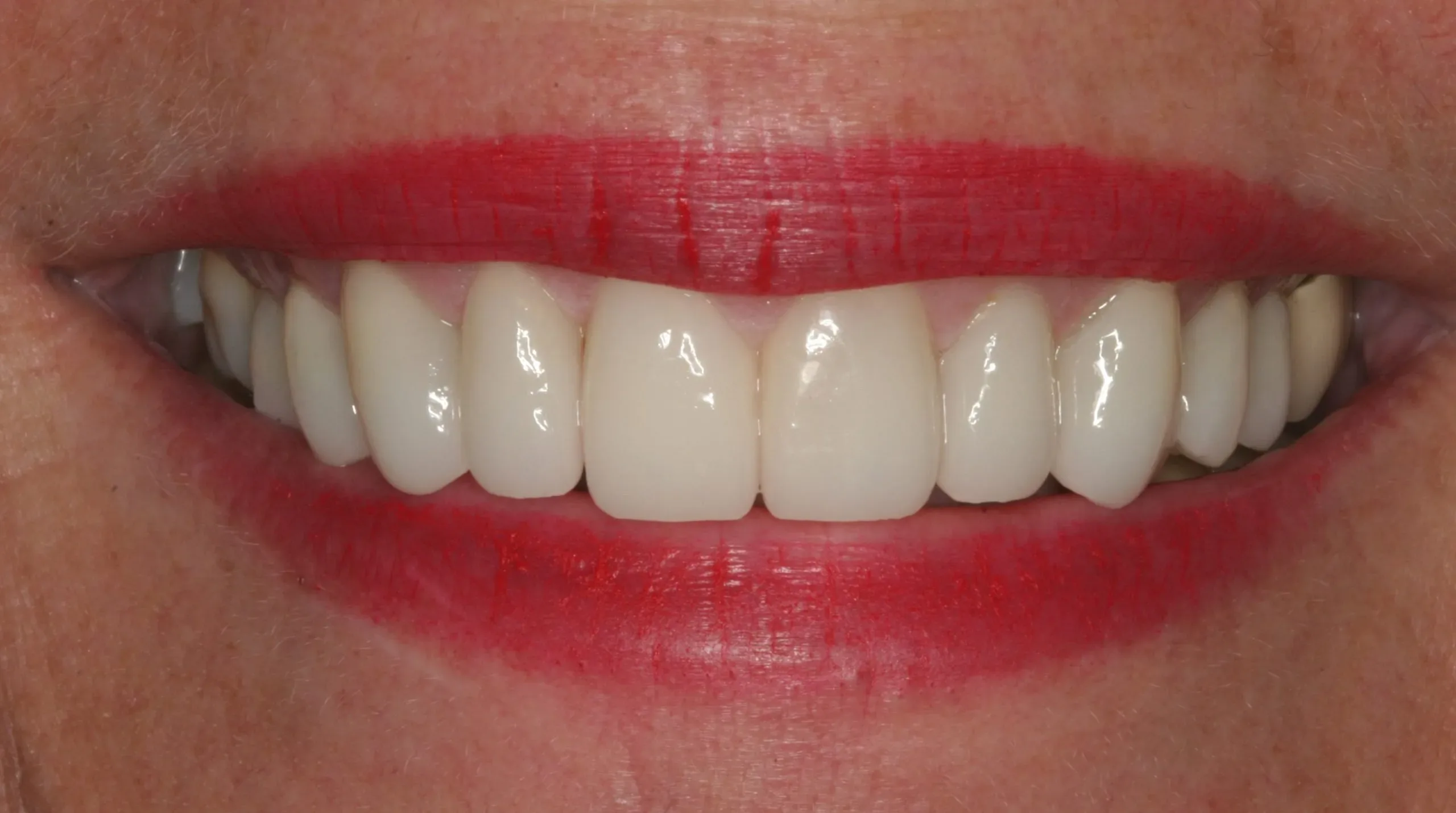 After treatment - Smile Enhancement