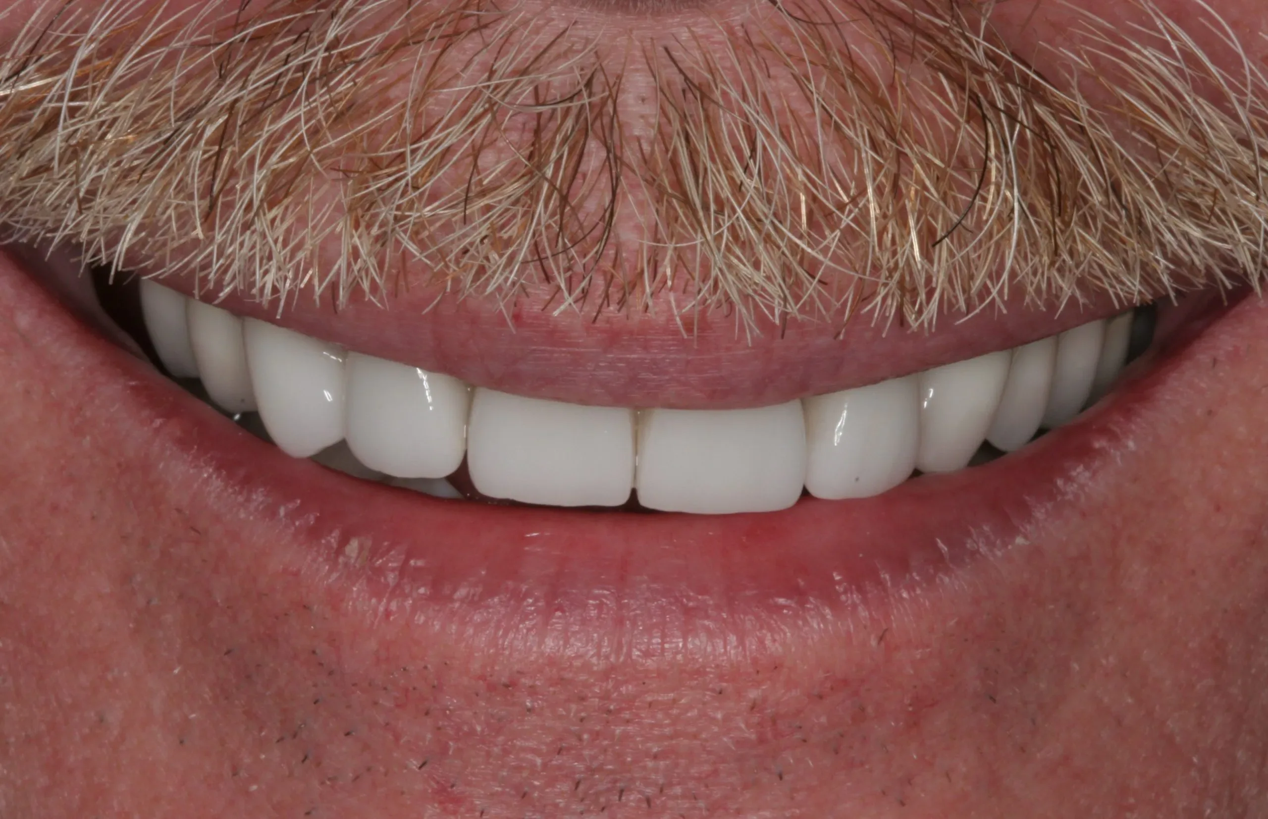 After: Cosmetic dental treatment smile view