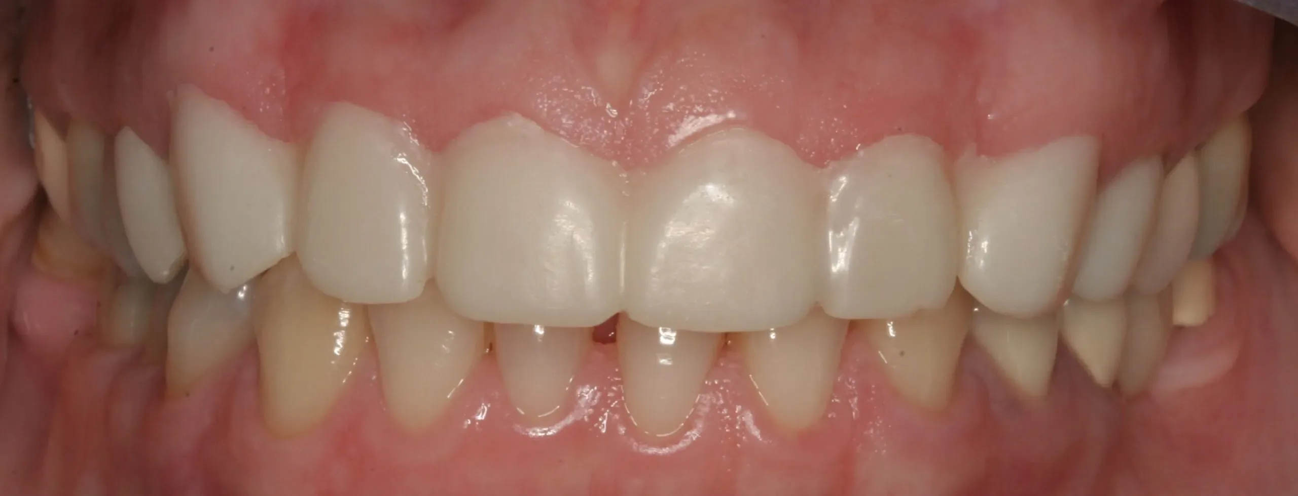 After treatment - Complete Smile Redesign
