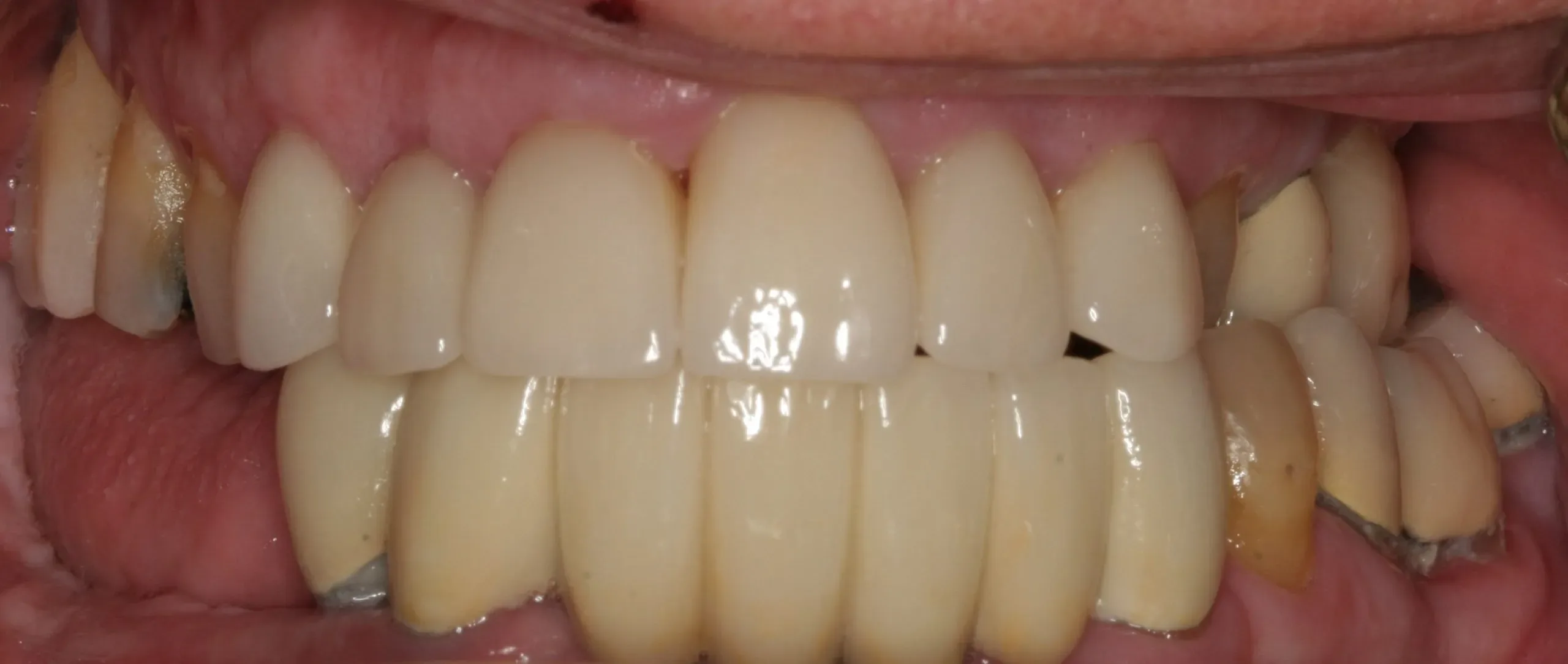 After smile brightening and reshaping