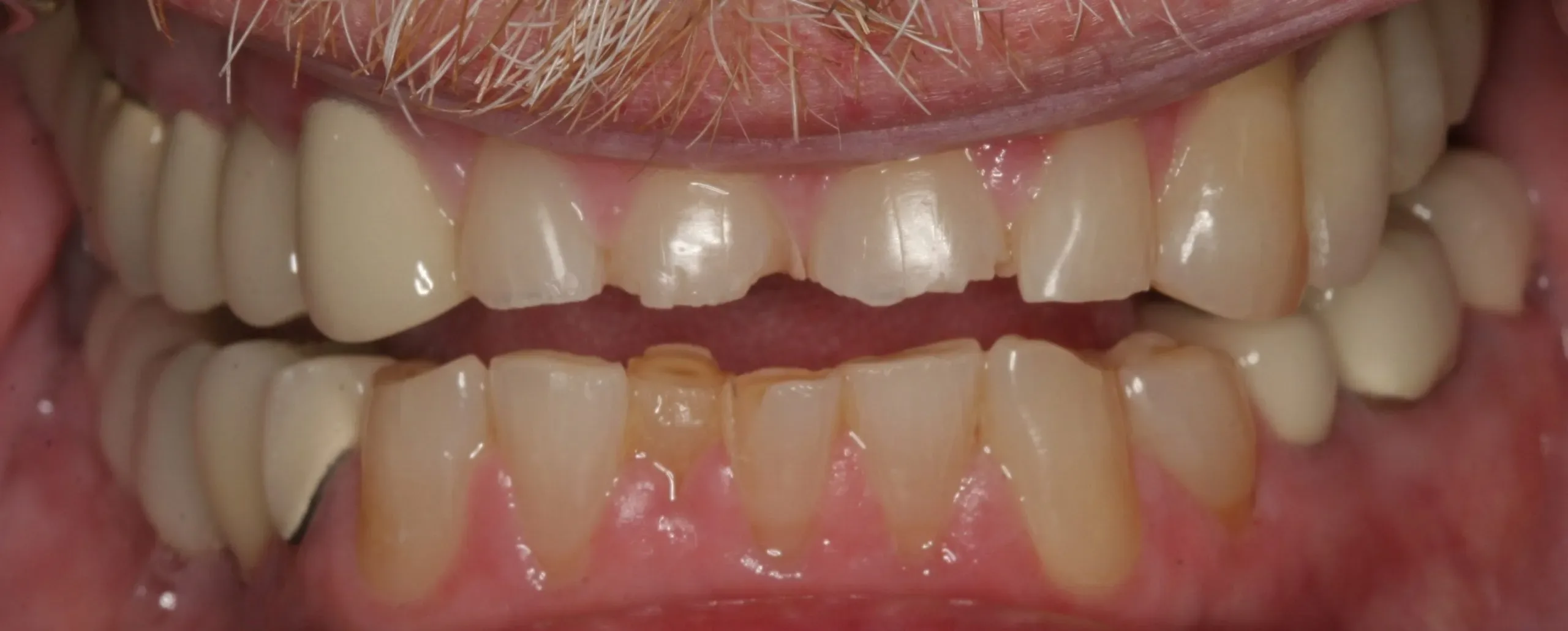 Before treatment - Restorative Smile Rehabilitation