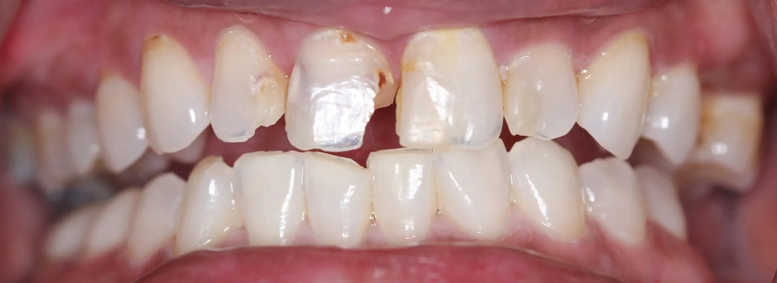 Before treatment - Cosmetic Correction