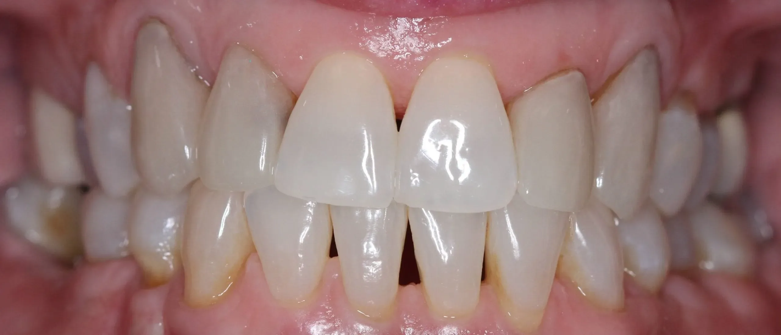 Before: Cosmetic dental treatment retracted view