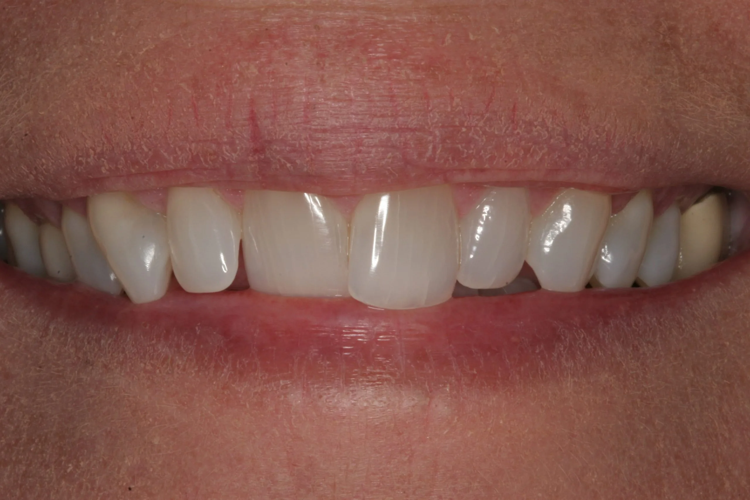 Before treatment - Smile Enhancement