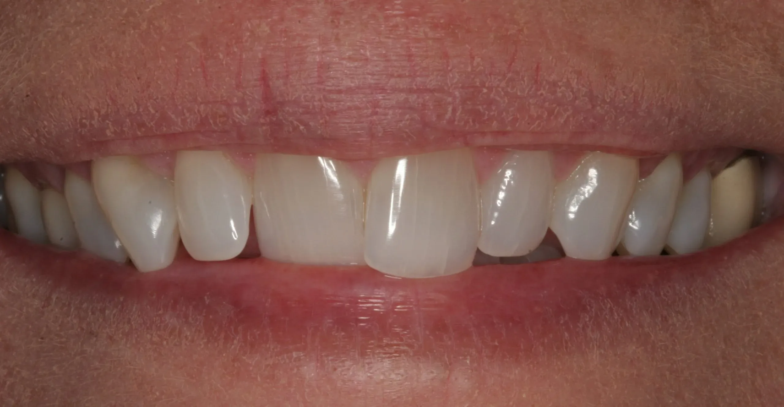 Before treatment - Functional and Cosmetic Restoration