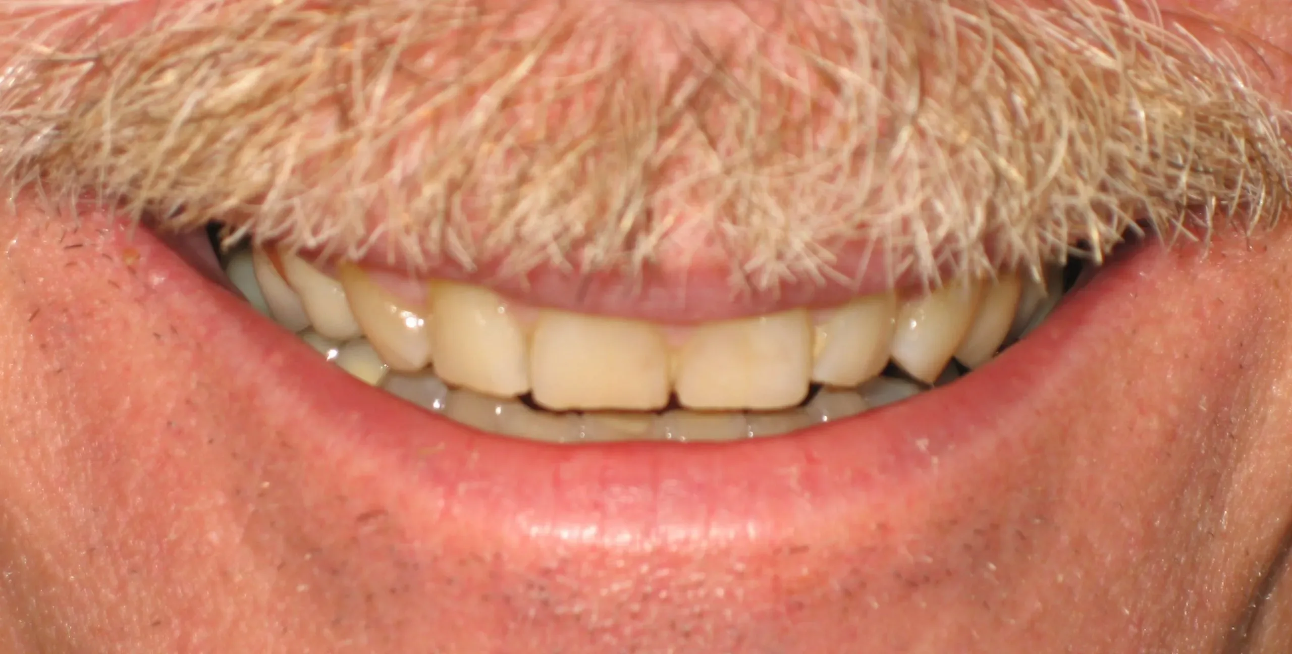 Before: Cosmetic dental treatment smile view