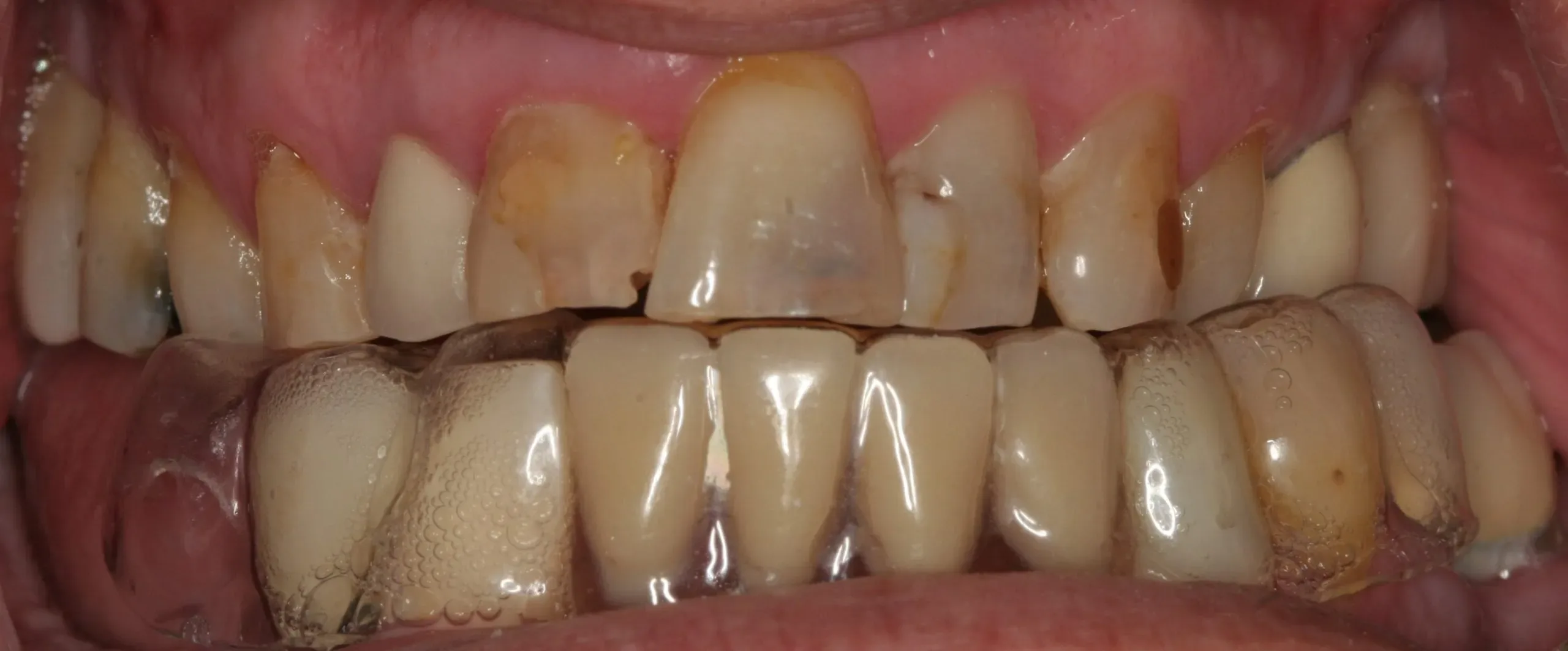 Before treatment - Complete Smile Redesign