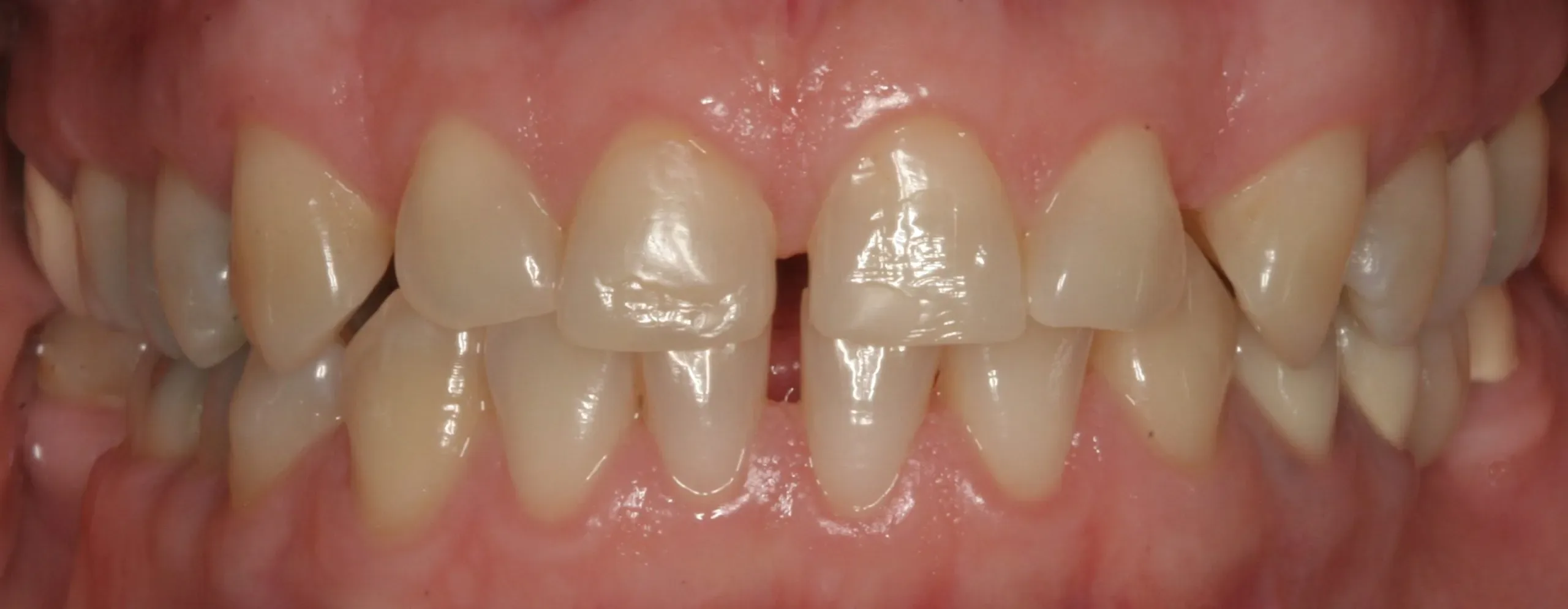 Before smile brightening and reshaping