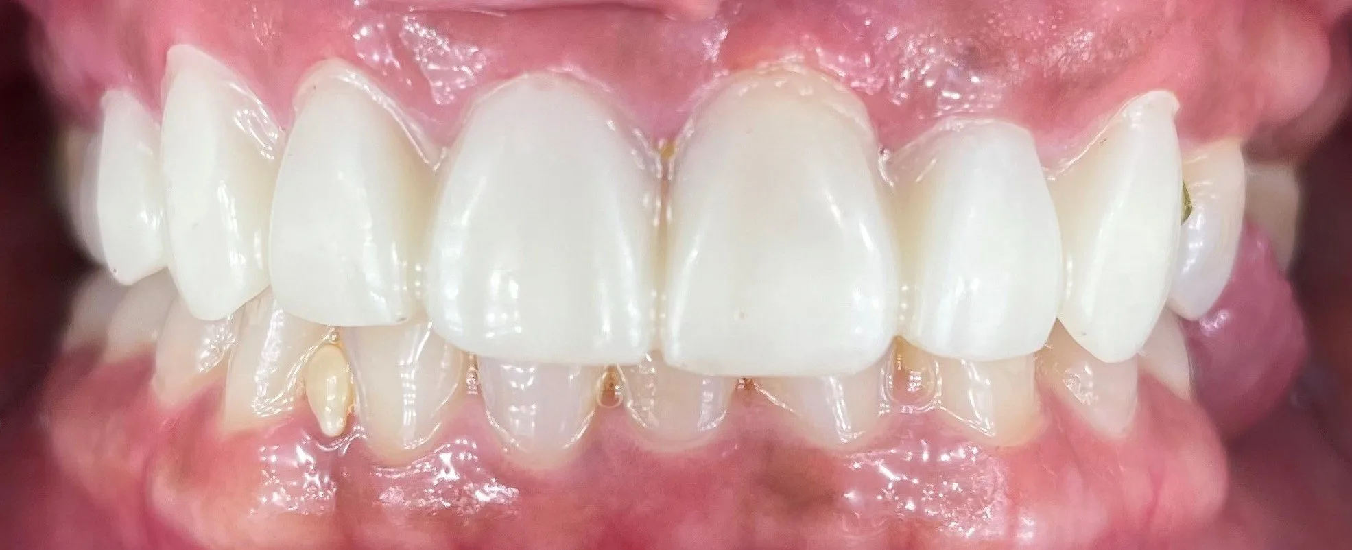 After treatment - Functional and Cosmetic Restoration