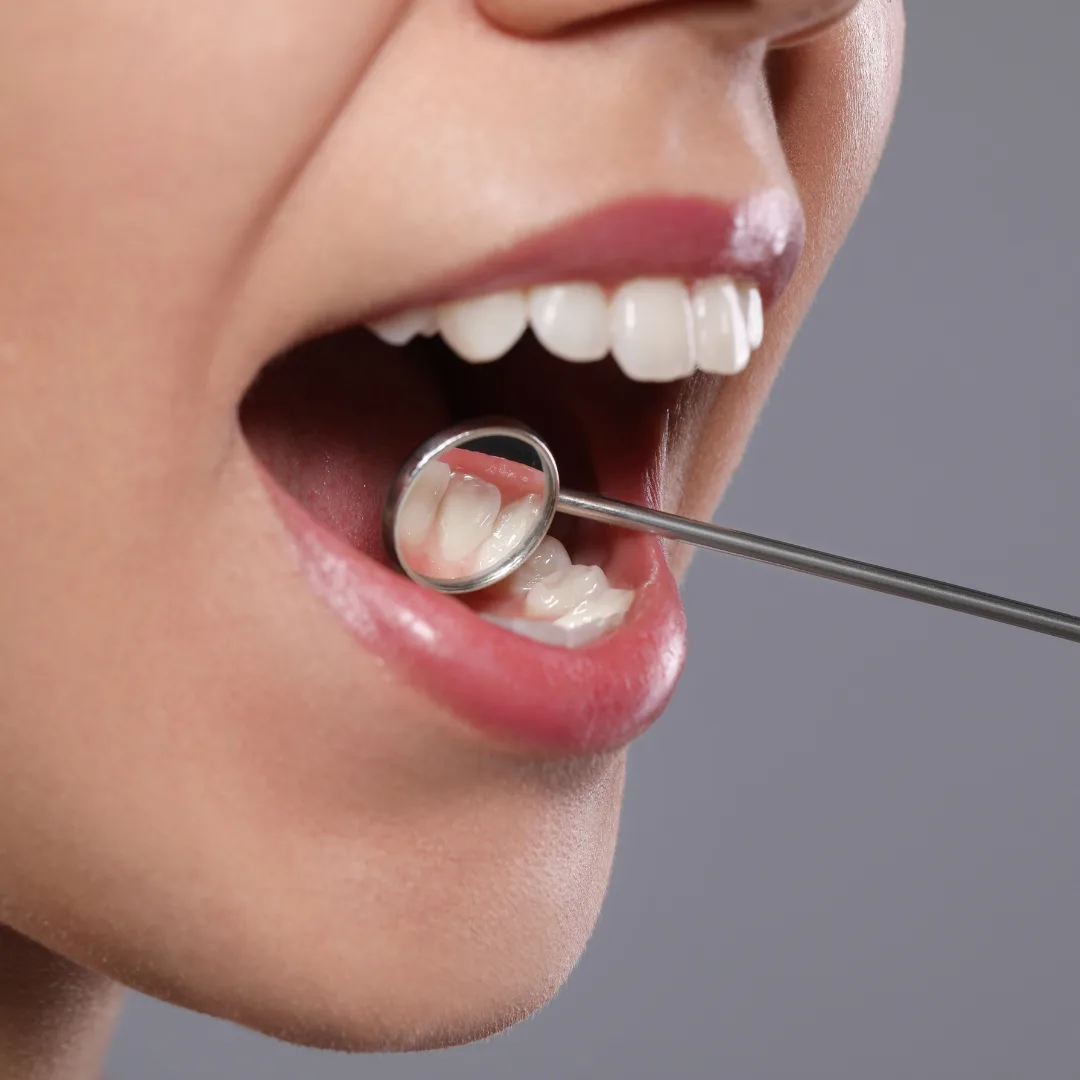 Dental Implant Longevity Tips