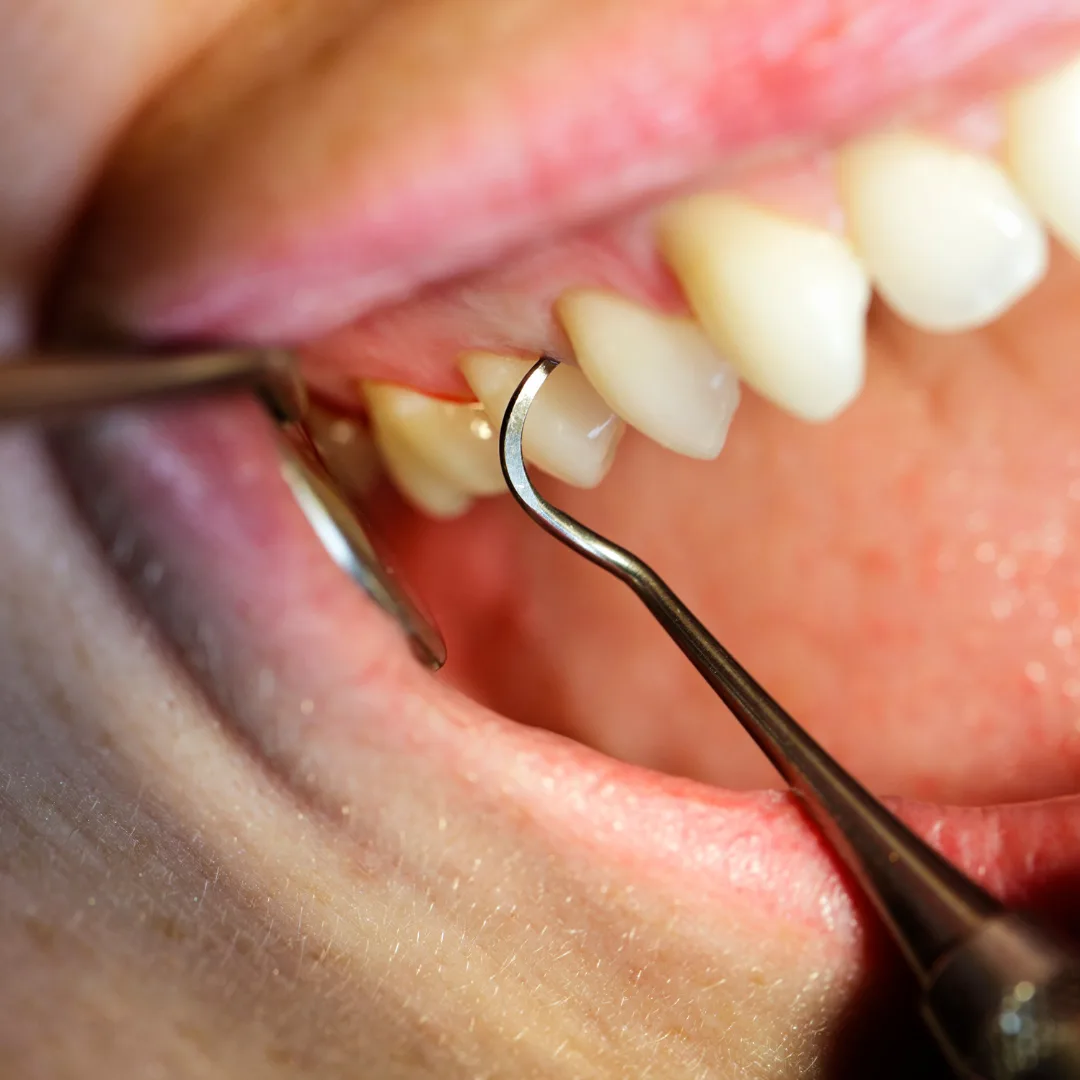 Why Routine Dental Cleanings Are Essential